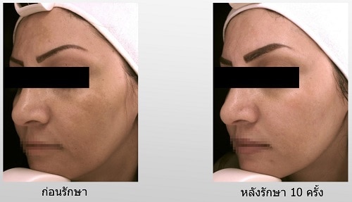 ทำตาสองชั้น เปิดหัวตา