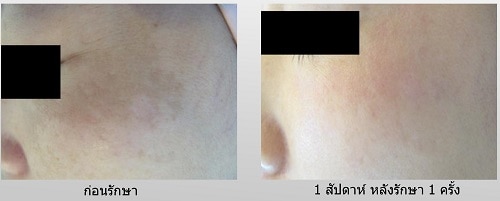 ทำตาสองชั้น เปิดหัวตา