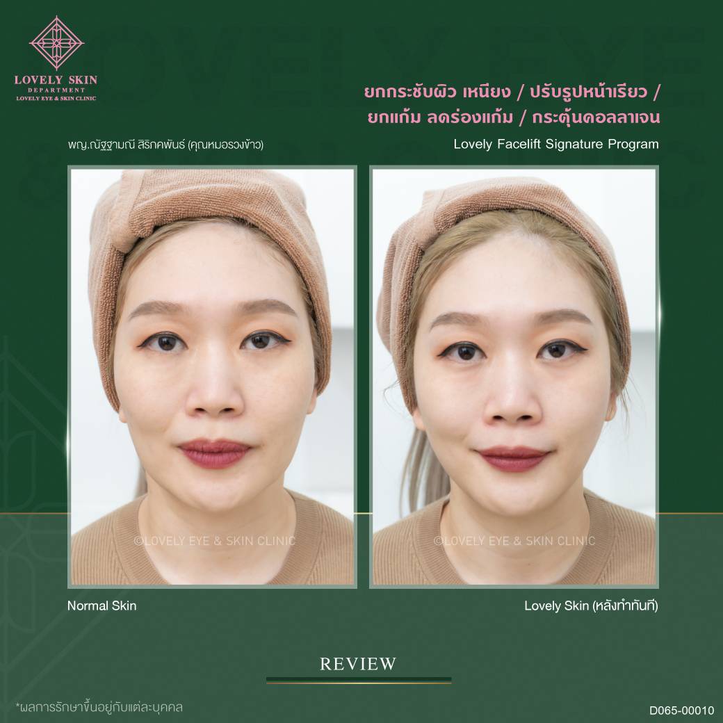 thermage FLX ยกกระชับผิว ลดเหนียง ปรับรูปหน้าให้เรียวเล็ก ลดร่องแก้ม และกระตุ้นคอลลาเจน