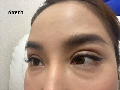 ตัดถุงใต้ตา