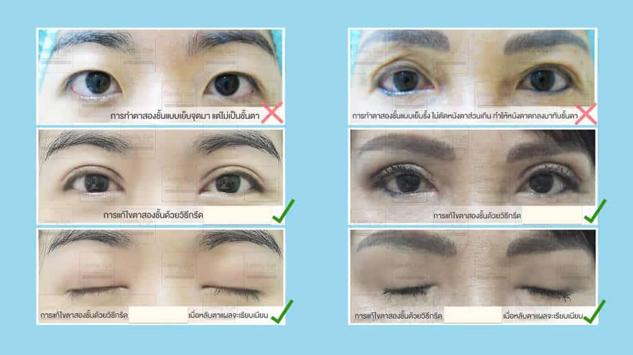 ทำตาสองชั้น เปิดหัวตา