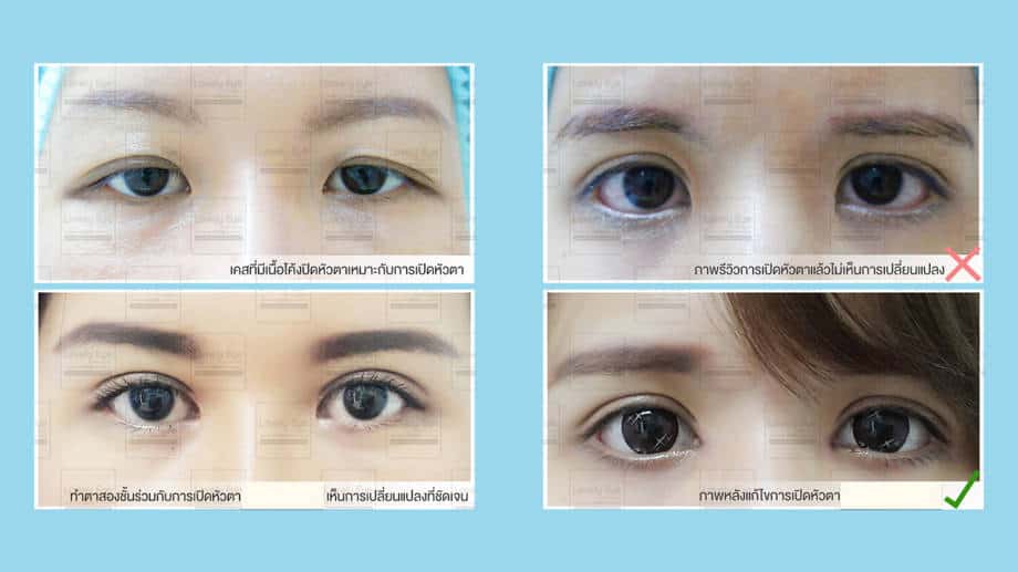 ทำตาสองชั้น เปิดหัวตา