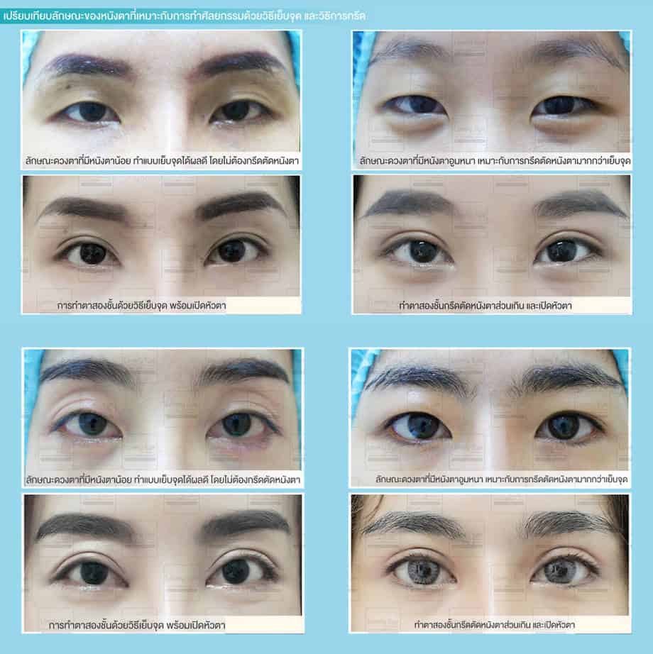ทำตาสองชั้น เปิดหัวตา