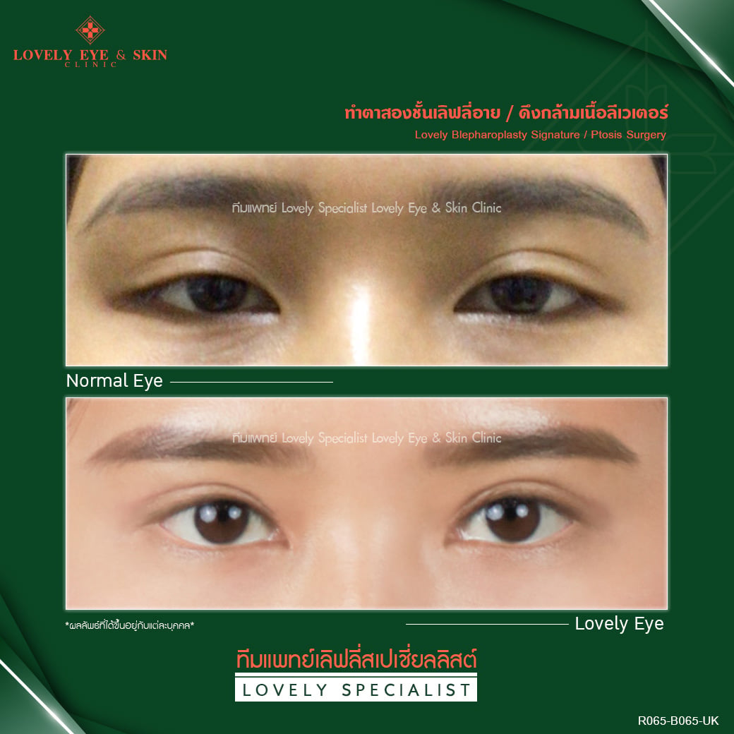 แก้ปัญหาตาปรือ ตาล้า ตาง่วง โดยทีมแพทย์ Lovely Specialist