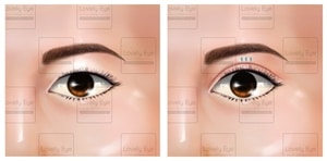 1.3 ทำตาสองชั้น แบบดึงกล้ามเนื้อตาลีเวเตอร์.jpg