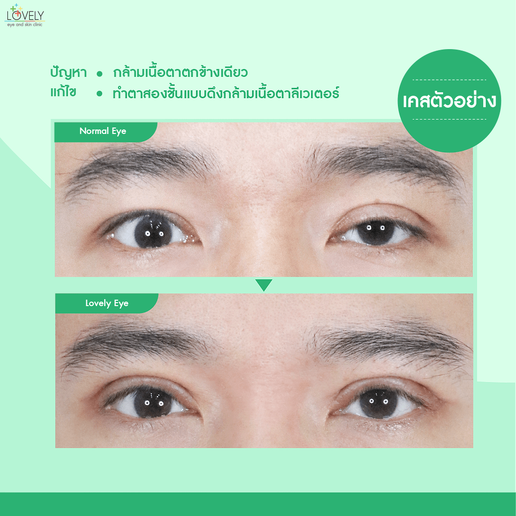 เคสตัวอย่าง_ทำตาสองชั้น ดึงกล้ามเนื้อตาลีเวเตอร์-3