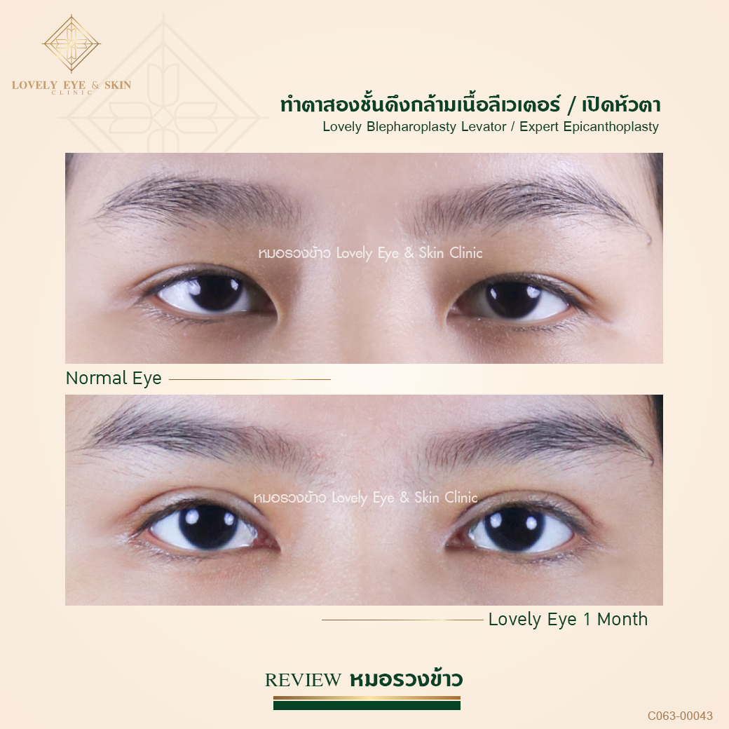 แก้ไขหนังตาตก ด้วยการทำตาสองชั้น ดึงกล้ามเนื้อตาลีเวเตอร์ พร้อมเปิดหัวตา