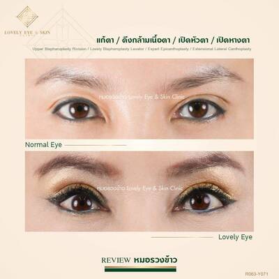 แก้ตาสองชั้น ตาพัง หนังตาตก