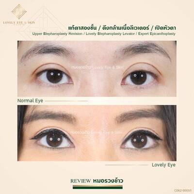 แก้ตาสองชั้น ตาพัง หนังตาตก