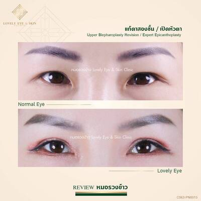 แก้ตาสองชั้น ตาพัง หนังตาตก