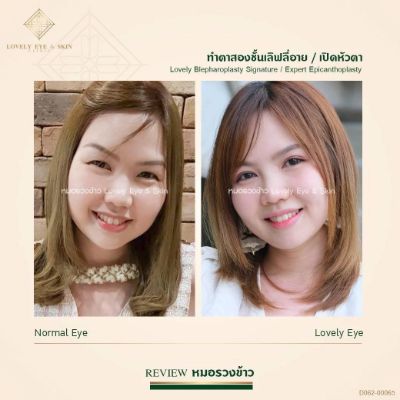 เคสคนไข้ทำตาสองชั้น พร้อมเปิดหัวตา