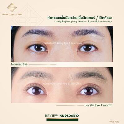 กล้ามเนื้อตาอ่อนแรง 