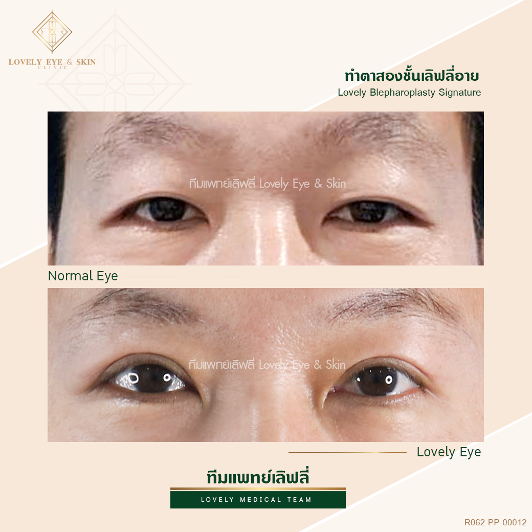 แก้ไขหนังตาตก ด้วยการทำตาสองชั้น พร้อมกำจัดหนังตาและไขมันเปลือกตาเกินออก
