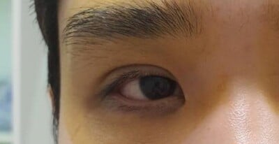 หนังตาปิดหัวตา เปิดหัวตา