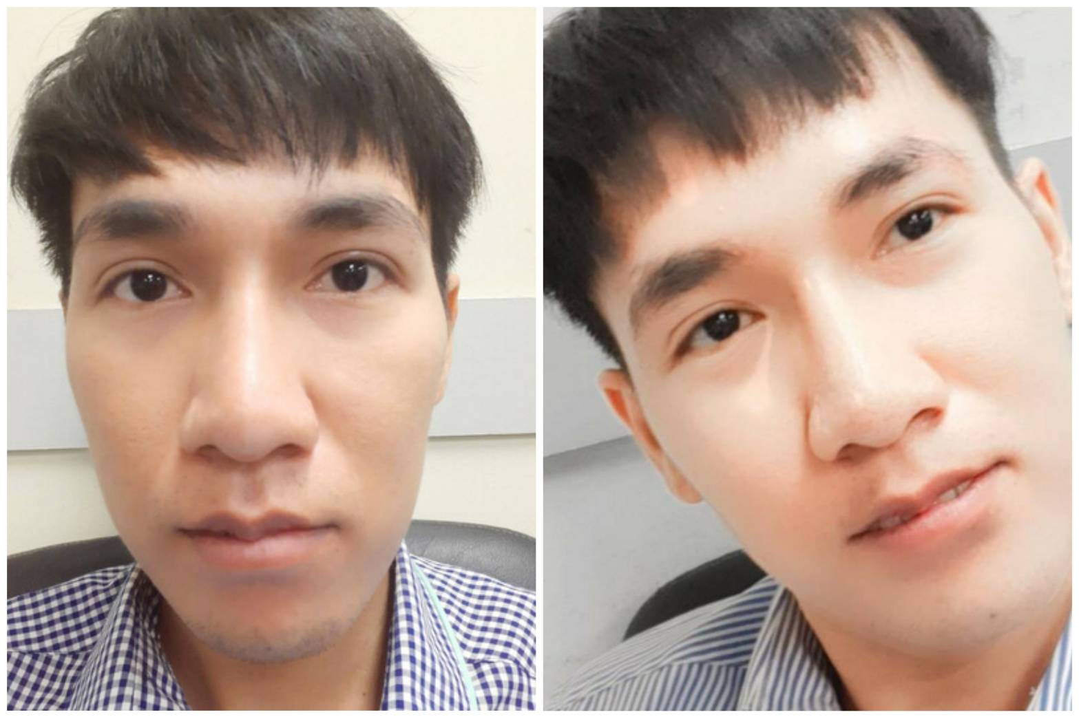 ยกหางตาซ่อนแผลใต้คิ้ว
