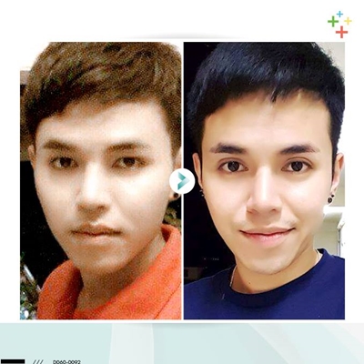 แก้ตาสองชั้น + เปิดหัวตา 
