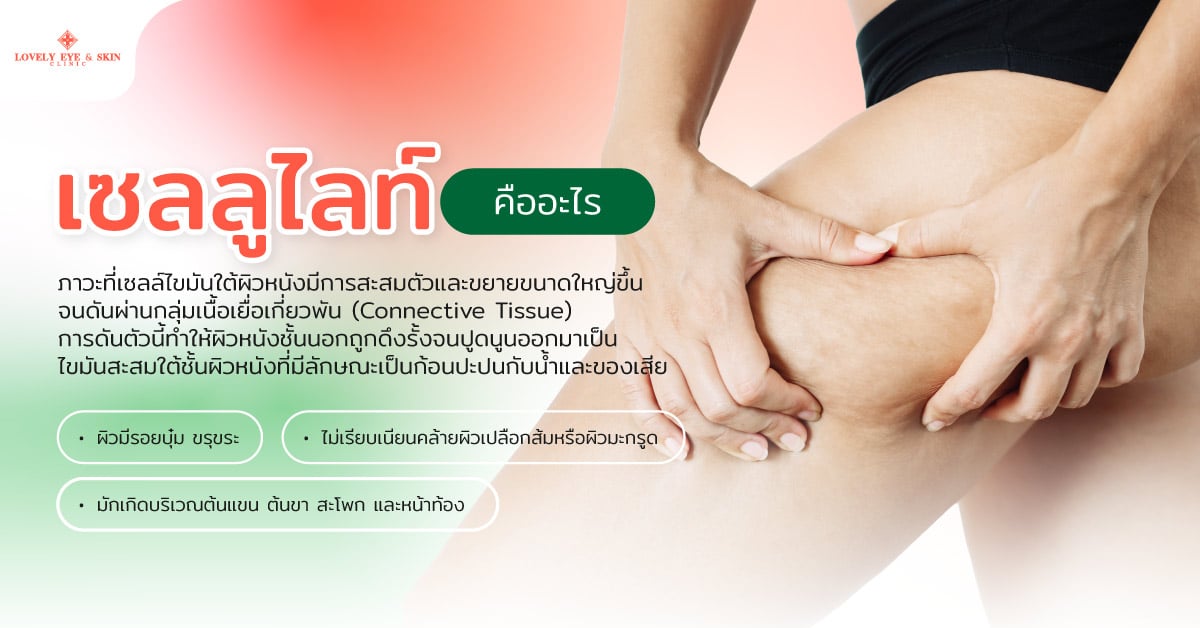 เซลลูไลท์ คืออะไร