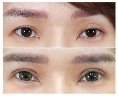 2 เบ้าตาลึก ไขมันเบ้าตาน้อย จนเห็นเป็นตาสามชั้น_2.png