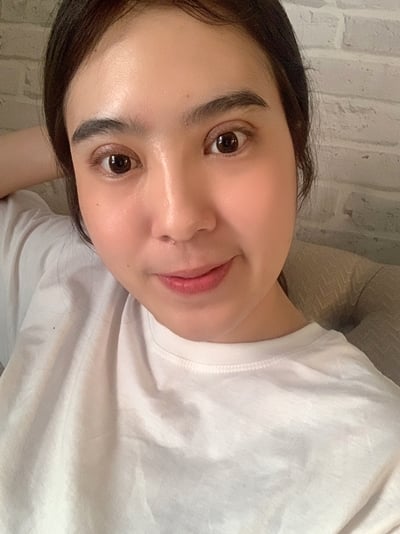 หลังทำตาสองชั้น 18 วัน รอเข้าที่ ถ้าหายบวมสนิท ขนาดชั้นตาจะพอดีกับดวงตา