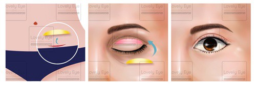 2.5 ทำตาสองชั้น ร่วมกับการปลูกถ่ายไขมันบริเ.jpg