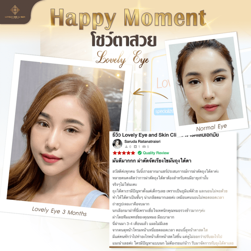 ตัดถุงใต้ตา