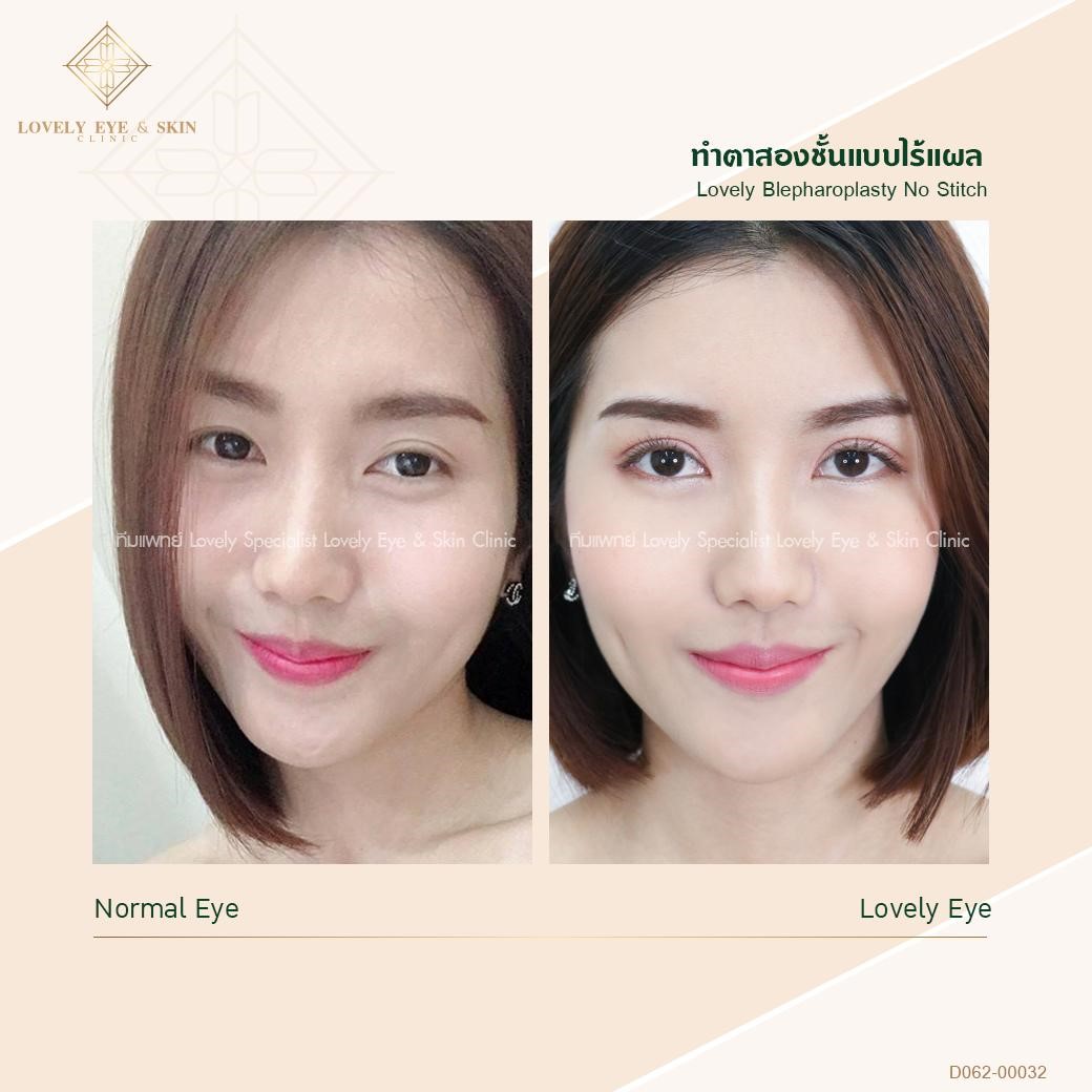 Lovely Blepharoplasty No Stich