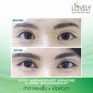 3.4 เปิดหัวตาเฉพาะ Expert Epicanthoplasty.jpg