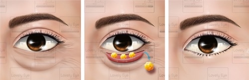3.5 เทคนิคตัดถุงใต้ตาและหนังส่วนเกินใต้ตา_0.jpg
