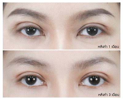 อาการที่พบและวิธีดูแลหลังทำตาสองชั้น | Lovely Eye Clinic