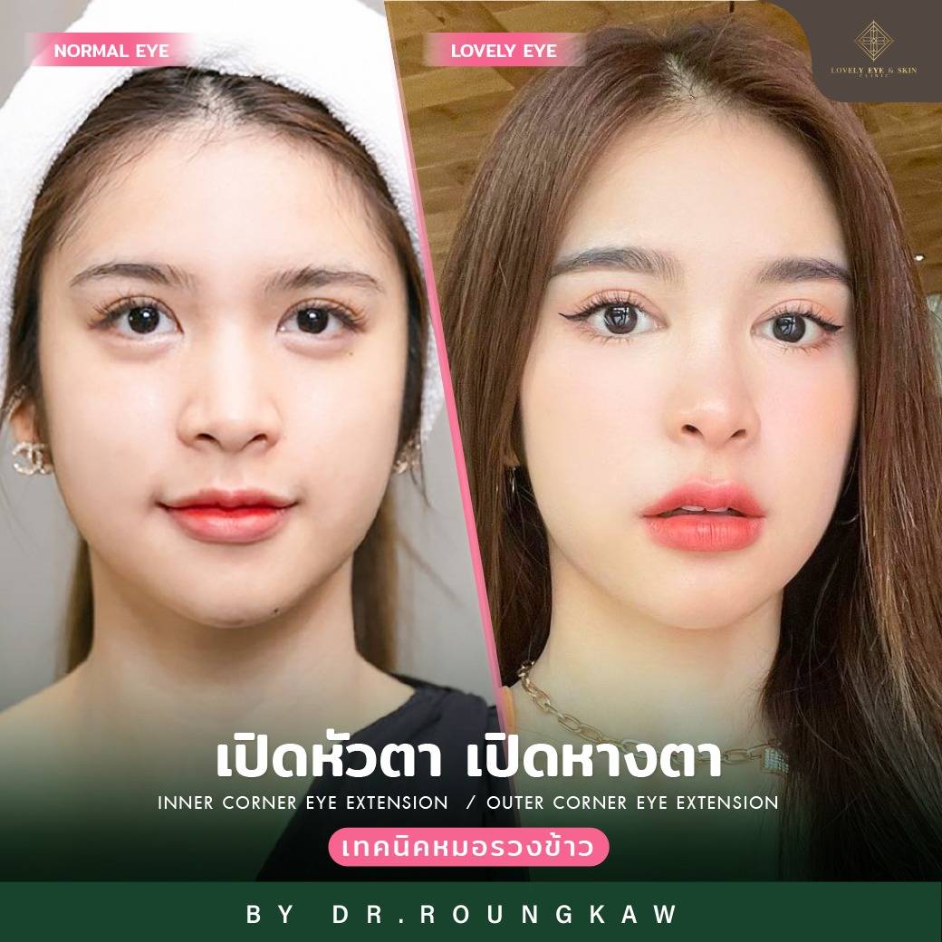 รีวิวก่อนทำ หลังทำ เปิดหัวตา หางตา กับหมอรวงข้าว