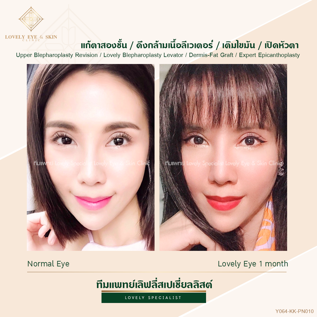 Upper Blepharoplasty Revision / Lovely Blepharoplasty Levator / Dermis-Fat Graft / Expert Epicanthoplasty