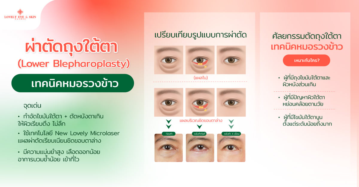 ผ่าตัดถุงใต้ตา (Lower Blepharoplasty) เทคนิคหมอรวงข้าว เป็นอย่างไร