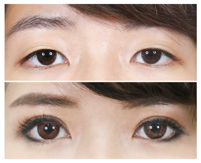 4. เปลือกตามีรอยกรีดเดิม ที่เคยทำตามาก่อน_3.png