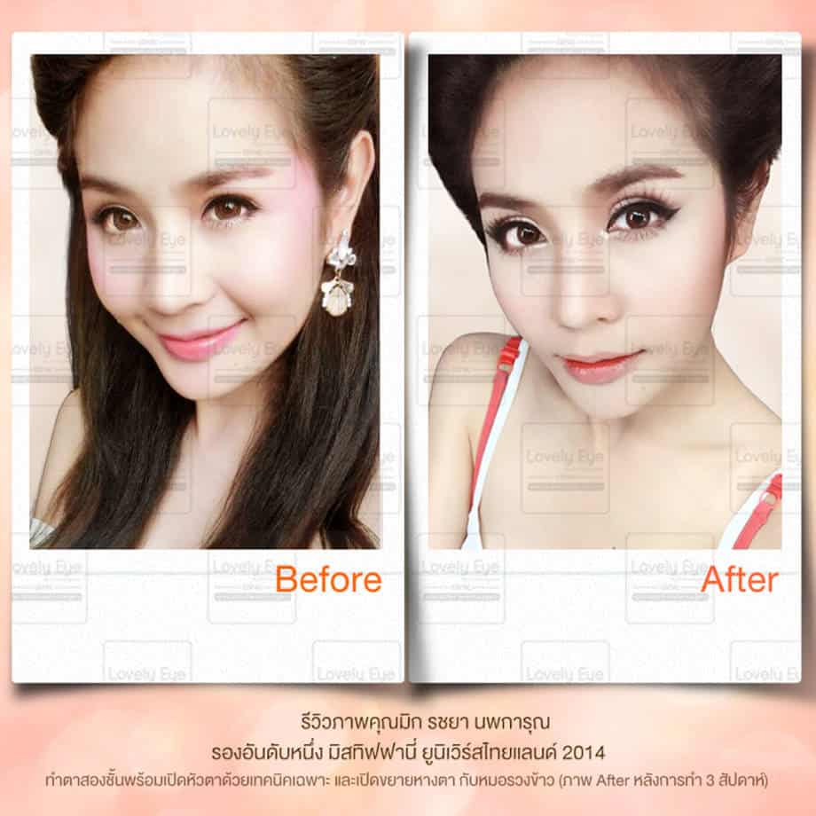ทำตาสองชั้น เปิดหัวตา