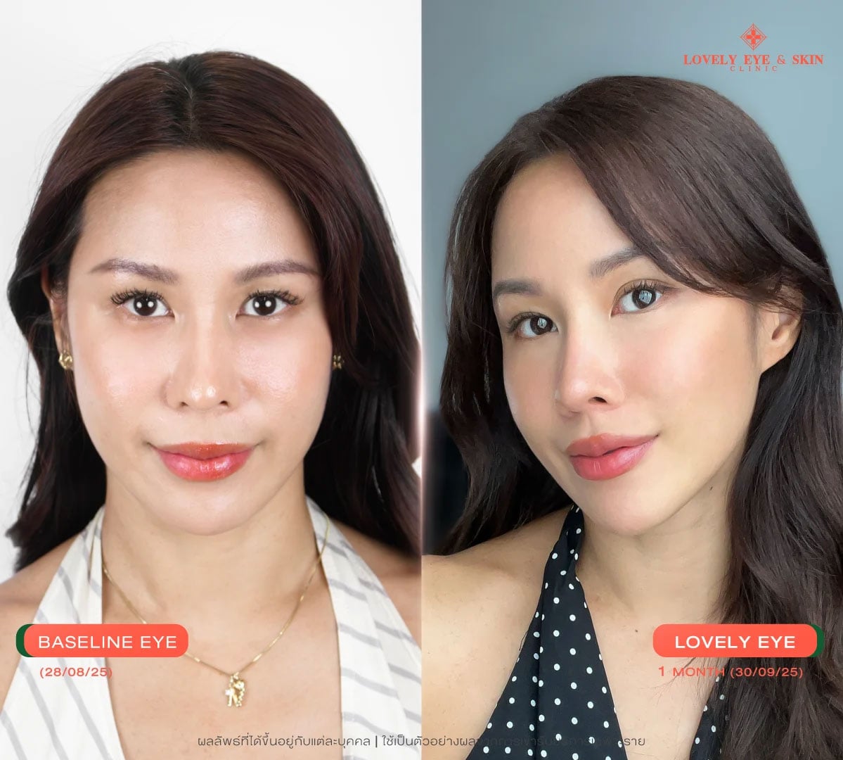 รีวิวโปรแกรม Lovely Eye Reborn (Thermage Eye) ที่ Lovely Eye & Skin Clinic