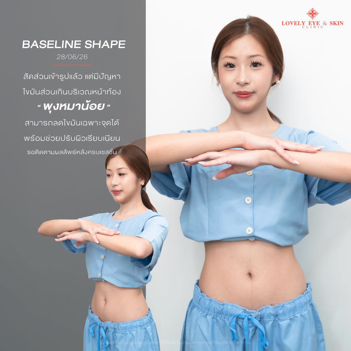 รีวิวลดเซลลูไลท์และดูแลรูปร่าง ที่ Lovely Eye & Skin Clinic