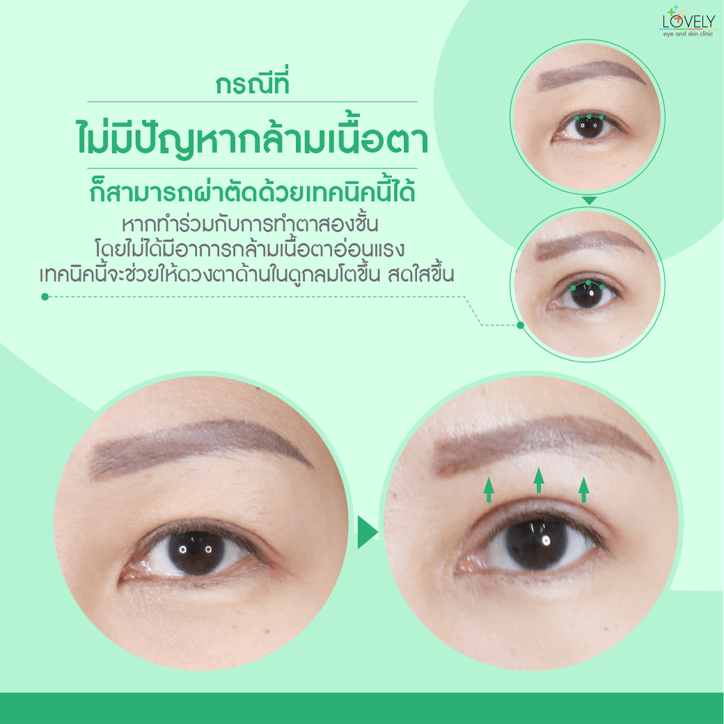 5 เปิดกล้ามเนื้อตา.png