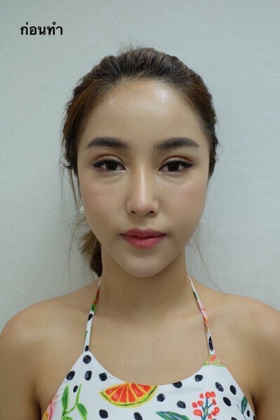 ตัดถุงใต้ตา