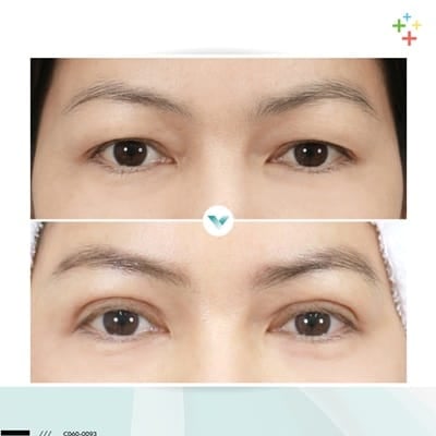 6 ทำตาสองชั้นแล้วหนังตาจะไม่เหลือเลย C093 วรรณพัฒน์ เกียรติศักดิ์ 2 ชั้น หมอรวงข้าว_1.jpg