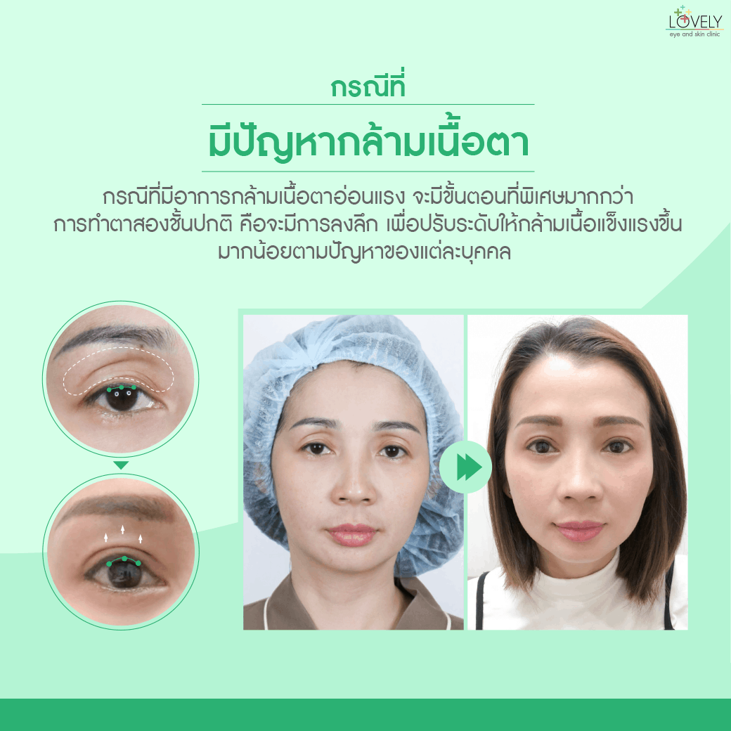 6 เปิดกล้ามเนื้อตา.png
