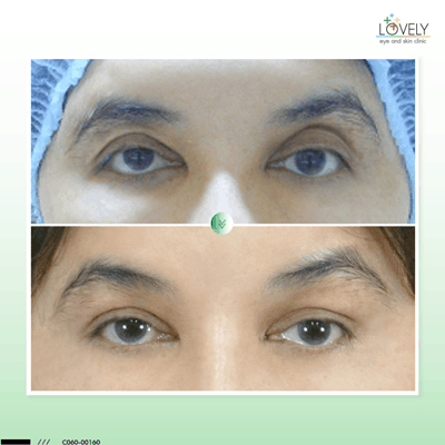 7 ทำตาสองชั้นจะสามารถแก้ไขได้ทุกปัญหา C0160 ทริ บุญเรือง 2ชั้น รักษากล้ามเนื้อ เติมไข_1.png