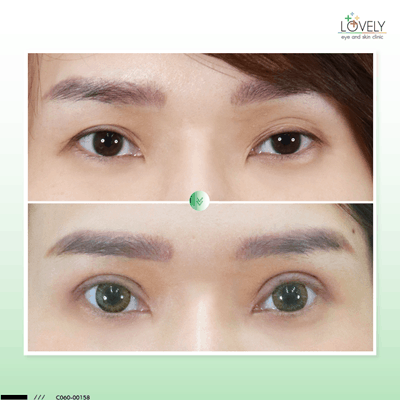 8 ทำตาสองชั้นให้เล็กกว่าตาสองชั้นเดิม C0158 ปวิชญา ใศมรรคดา แก้ตา รักษากล้ามเนื้อ เต_0.png