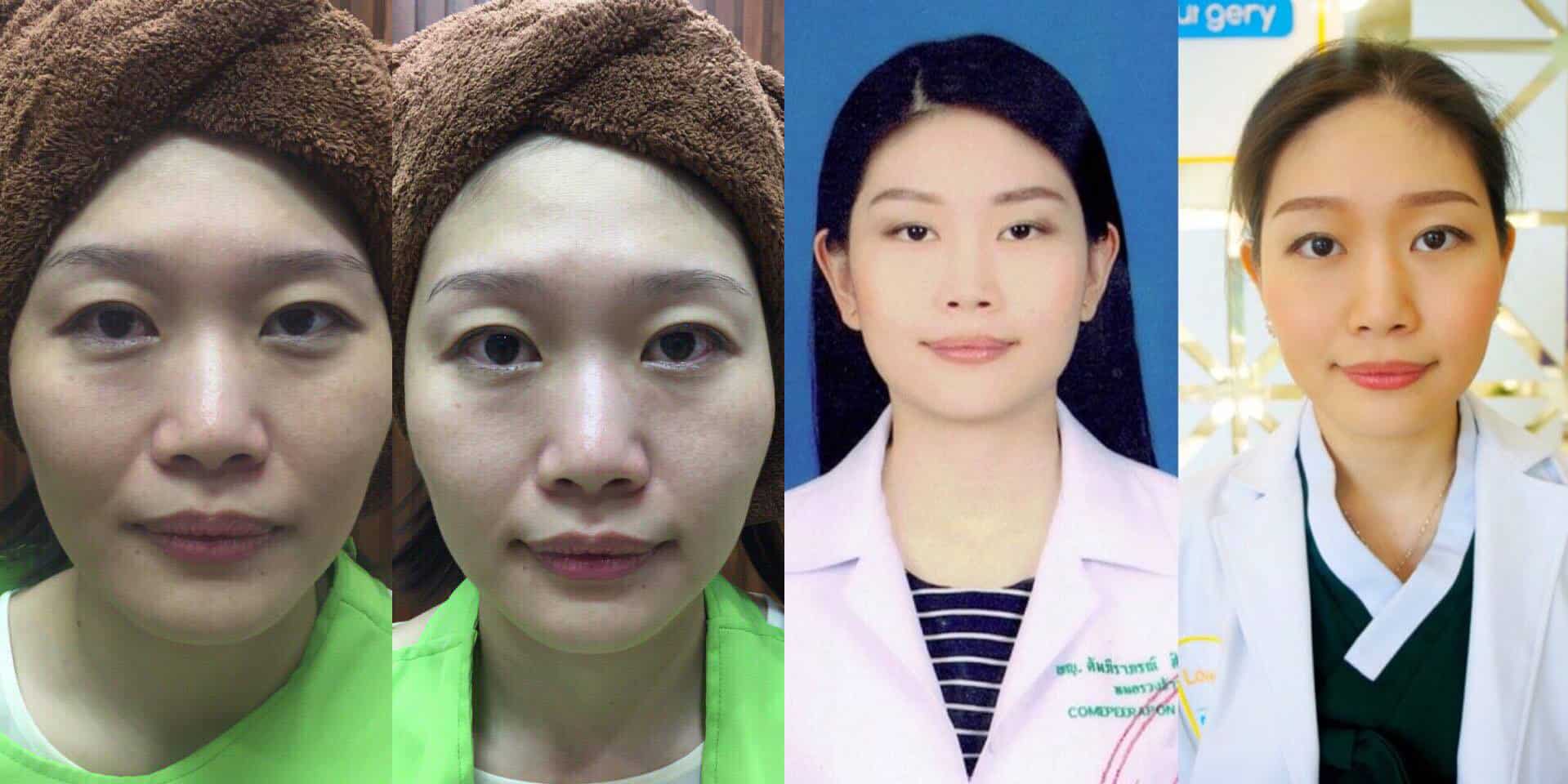 ทำตาสองชั้น เปิดหัวตา