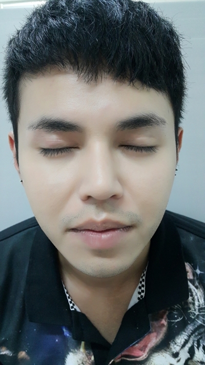 แก้ตาสองชั้น + เปิดหัวตา 