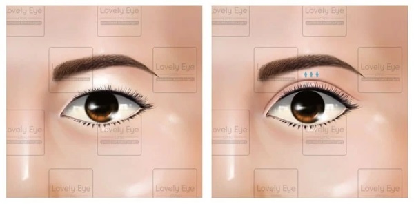 รักษากล้ามเนื้อตาอ่อนแรง (Ptosis)