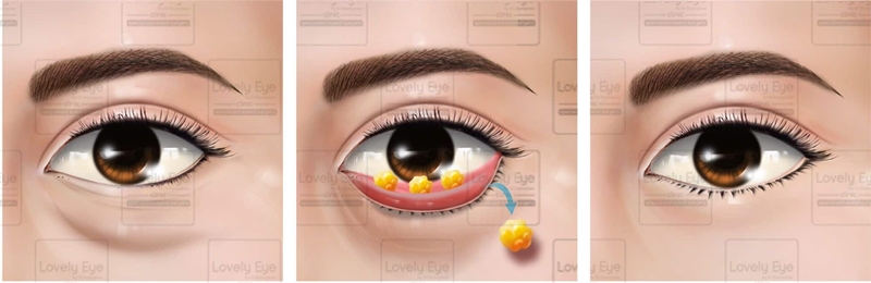 เลเซอร์ตัดถุงใต้ตาไร้แผล กำจัดถุงไขมันใต้ตาจากด้านในเปลือกตา โดยใช้ New Lovely Microlaser