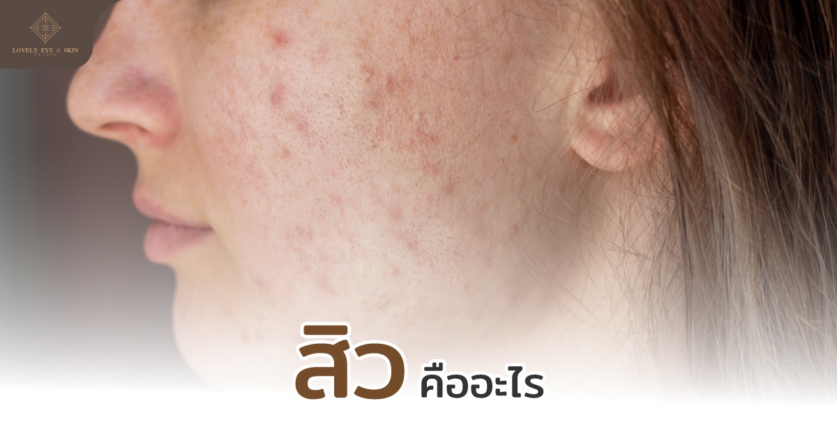 สิว (Acne) คือ สภาพผิวทั่วไปที่เกิดการอุดตันของไขมัน หรือเซลล์ผิวที่ตายแล้วบริเวณรูขุมขน