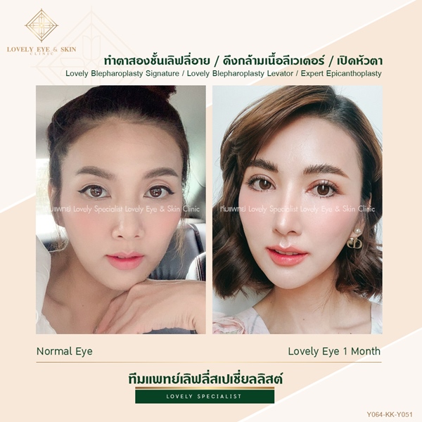 เคสทำตาสองชั้น ดึงกล้ามเนื้อตา เปิดหัวตาเทคนิคหมอรวงข้าว แก้ปัญหากล้ามเนื้อตาอ่อนแรง