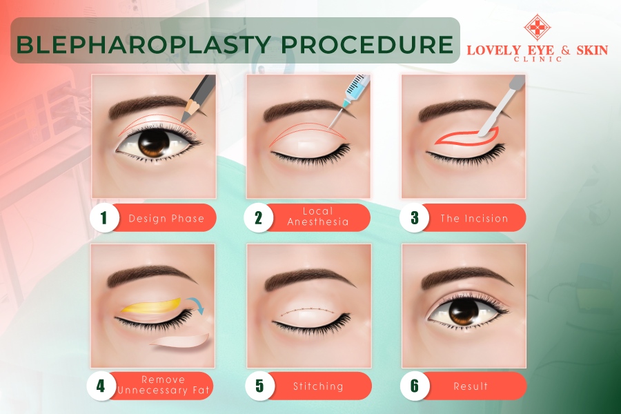 Upper blepharoplasty is a cosmetic procedure that aims to improve the appearance of the upper eyelids