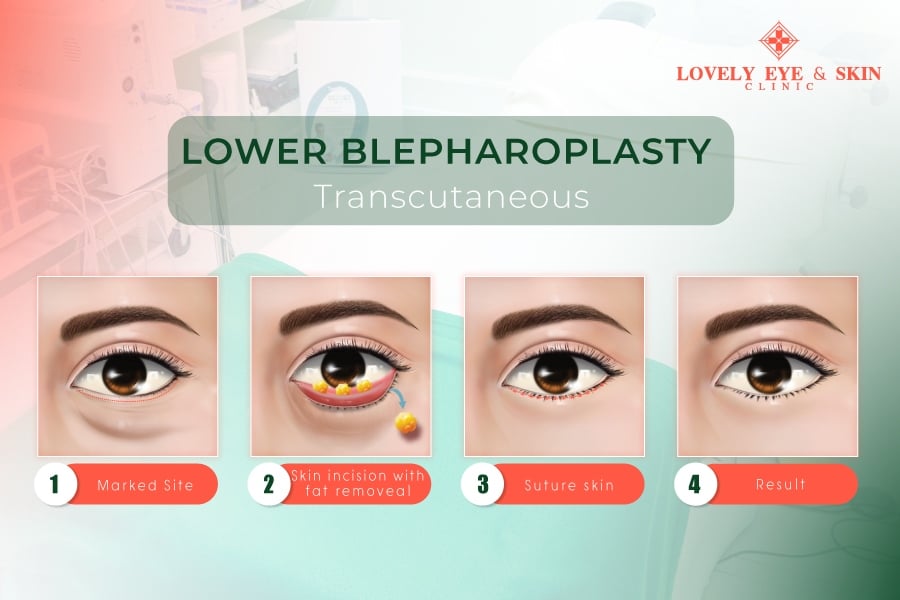 Lower blepharoplasty is a surgical procedure aimed at rejuvenating the lower eyelids